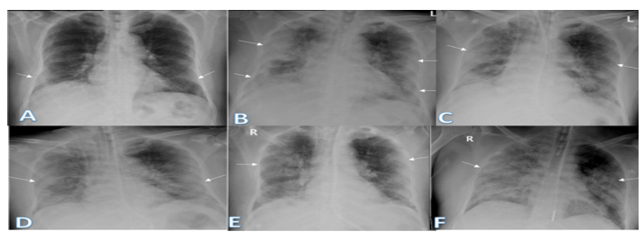 Chest X-Ray Report Analysis