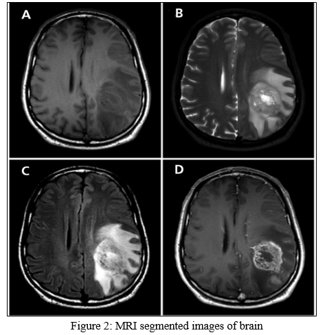 Brain Tumor Detection Using Deep Learning