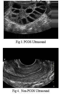 PCOS Detection: A Study of the Literature